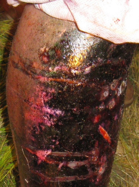 Gangrene Leg